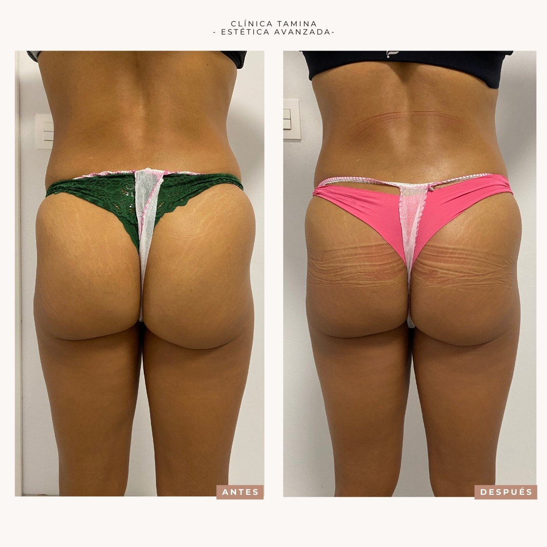 Molding-fit-antes-despues.jpg