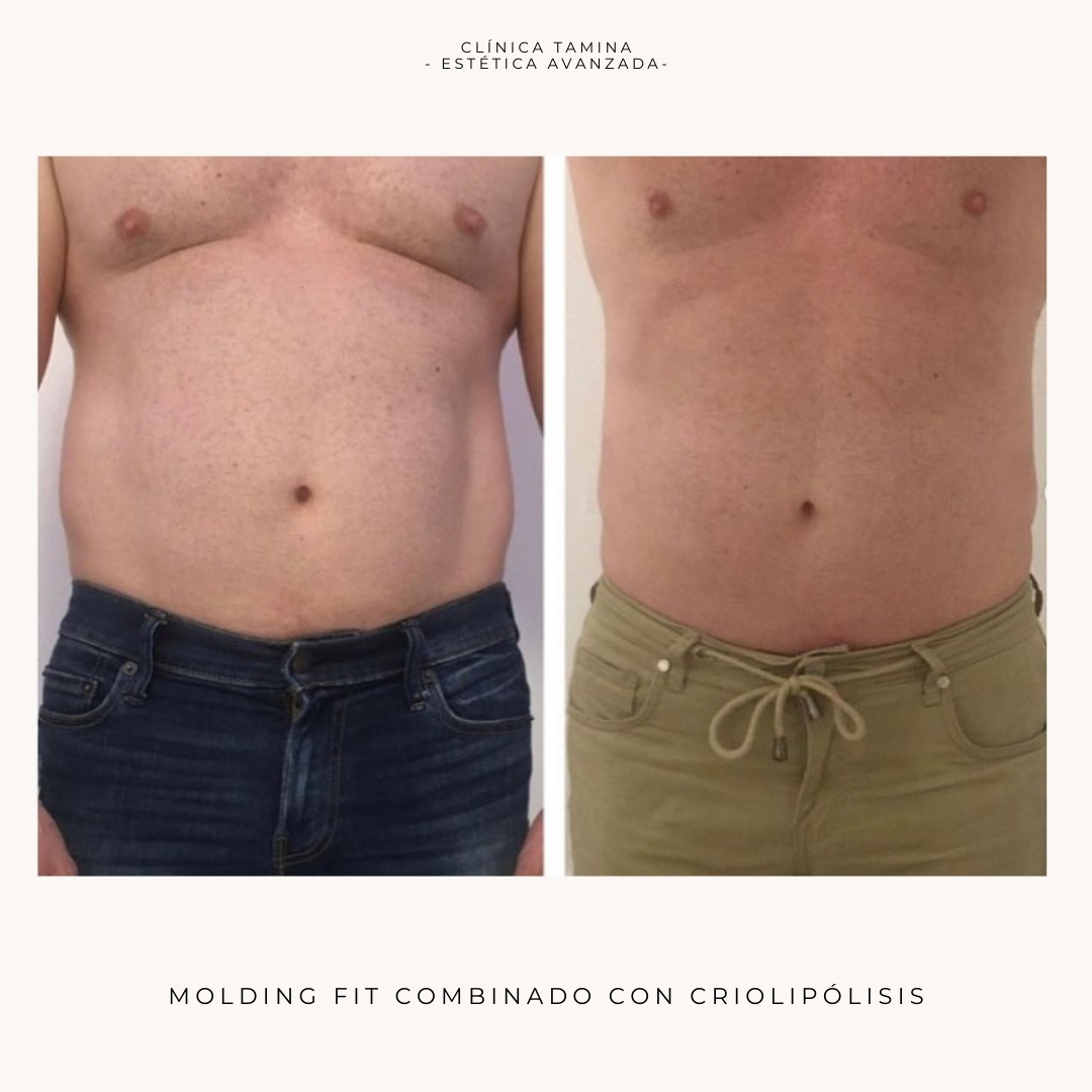 molding-fit-con-criolipolisis-2.jpg