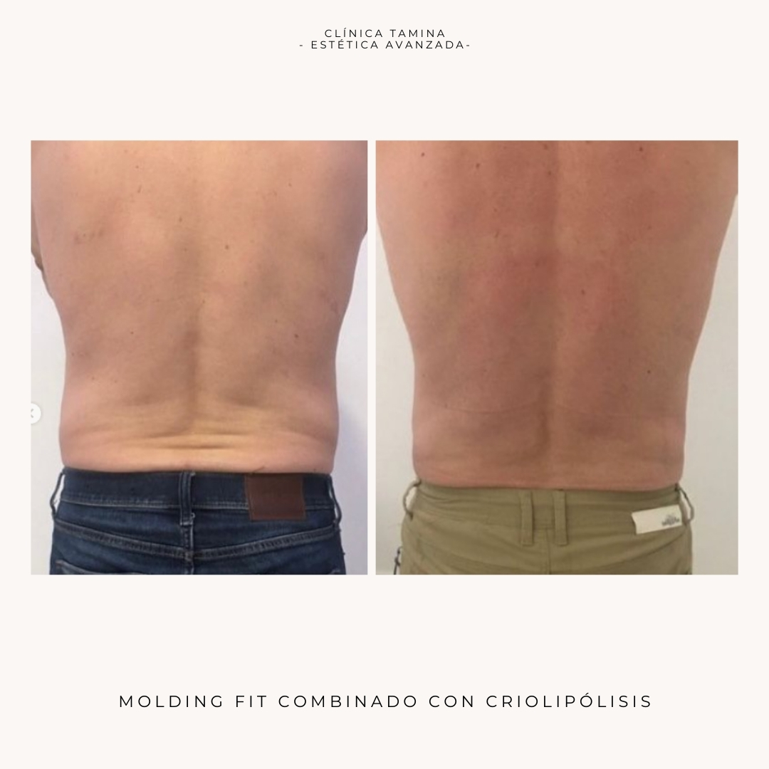 molding-fit-con-criolipolisis-3.jpg