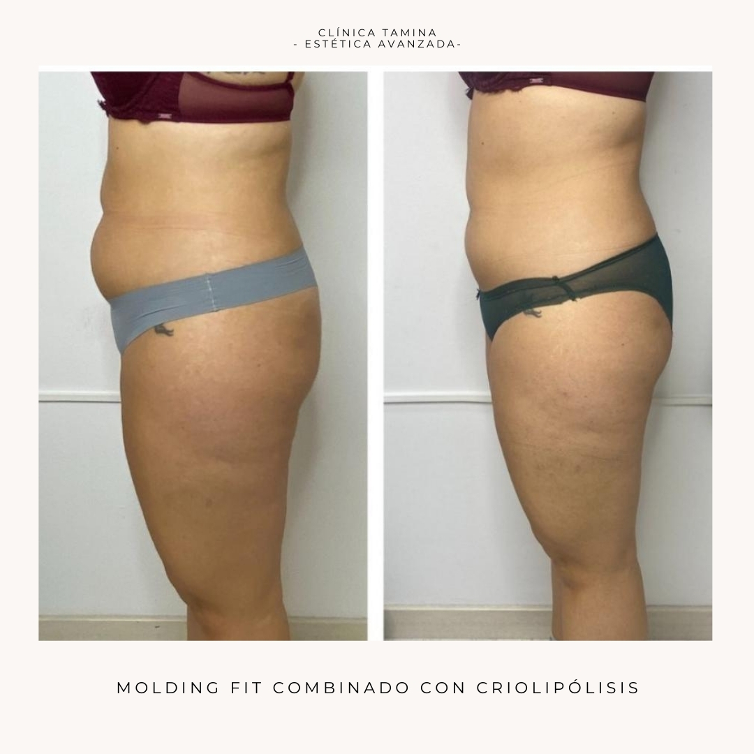 molding-fit-con-criolipolisis-antes-y-despues.jpg