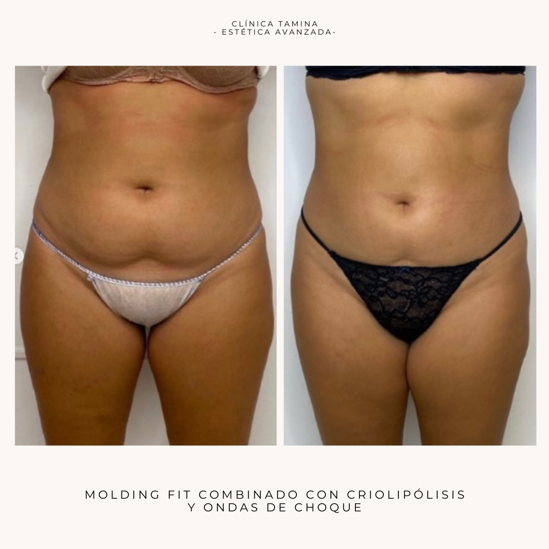 molding-fit-criolipolisis-ondas-de-choque-2.jpg
